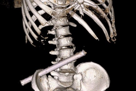 Чувашские врачи извлекли из мужчины 25-сантиметровую трубу