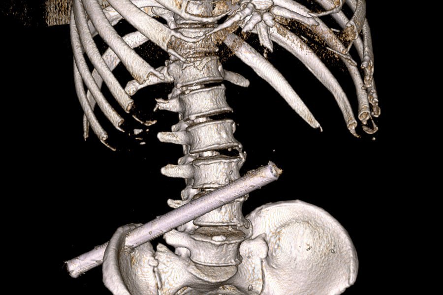 Чувашские врачи извлекли из мужчины 25-сантиметровую трубу