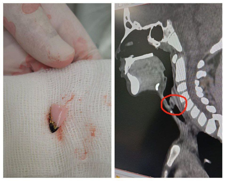 Опасный случай в Алатыре: врачи извлекли предмет из трахеи ребенка