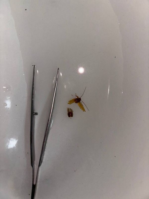 Врачи РДКБ извлекли из уха подростка живое насекомое